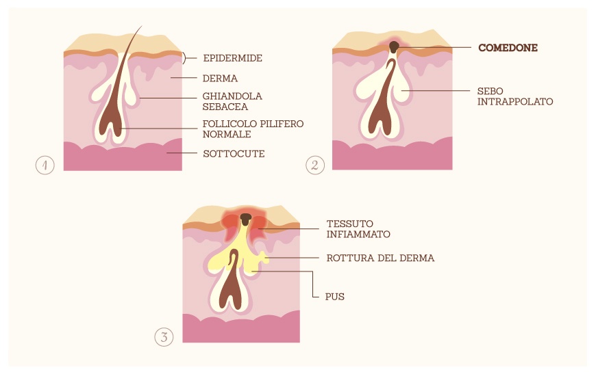 Cicatrici da acne i rimedi naturali per trattarle al meglio